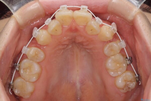 見えないほど重なっている前歯　抜歯矯正でスッキリとした歯並びに 治療途中画像