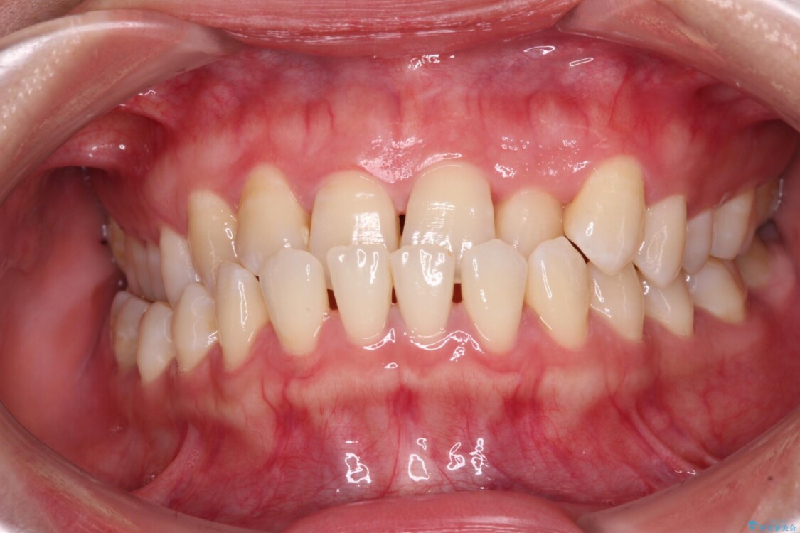 前歯の反対咬合　急速拡大装置とワイヤー装置であっという間の矯正治療 治療前