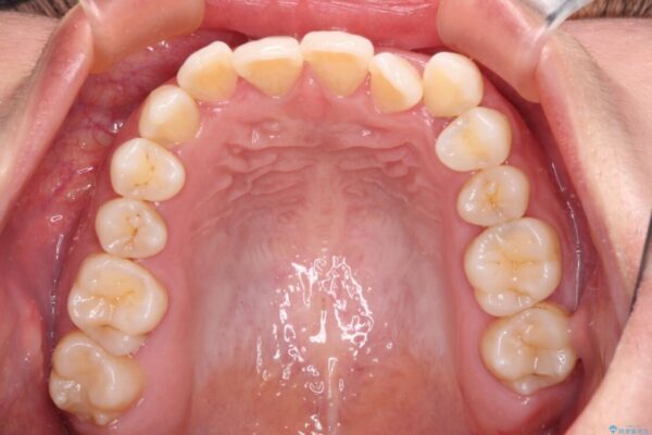 前歯の反対咬合　急速拡大装置とワイヤー装置であっという間の矯正治療 治療前画像