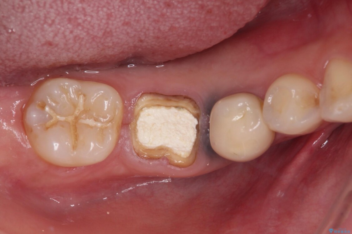 抜歯と言われた奥歯を残したい　奥歯を保存するセラミック治療 治療前