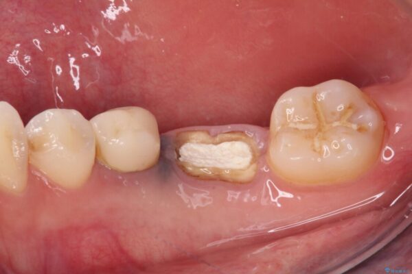 抜歯と言われた奥歯を残したい　奥歯を保存するセラミック治療 治療前画像