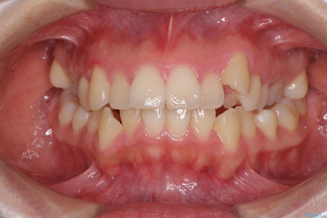 狭い歯列を拡大　拡大装置を併用したインビザライン矯正 治療前