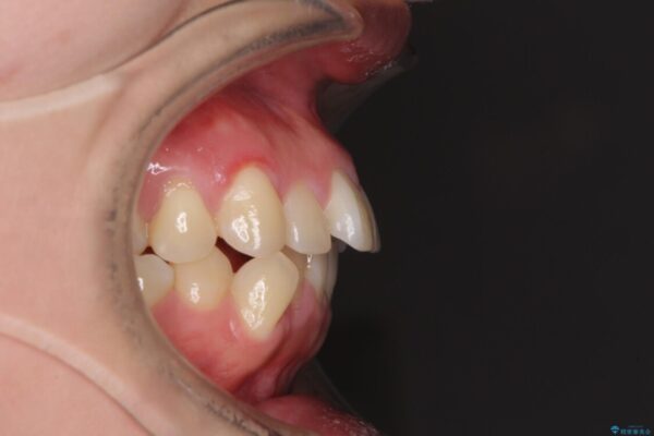 狭い歯列を拡大　拡大装置を併用したインビザライン矯正 治療前画像