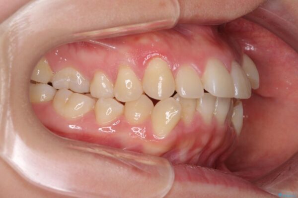 狭い歯列を拡大　拡大装置を併用したインビザライン矯正 治療前画像