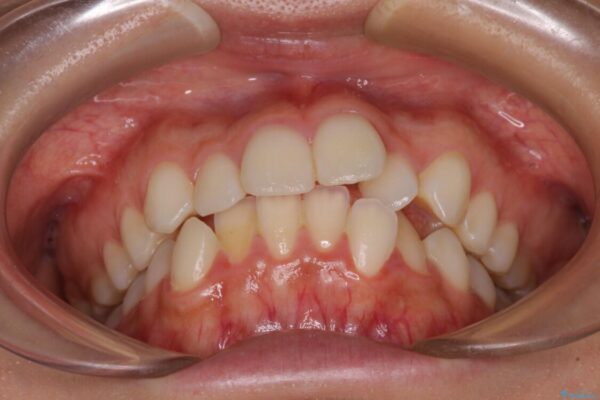 【モニター】前歯のクロスバイトをインビザラインで治療 治療前画像