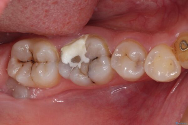 放置した虫歯　根管治療とオールセラミッククラウン 治療前画像