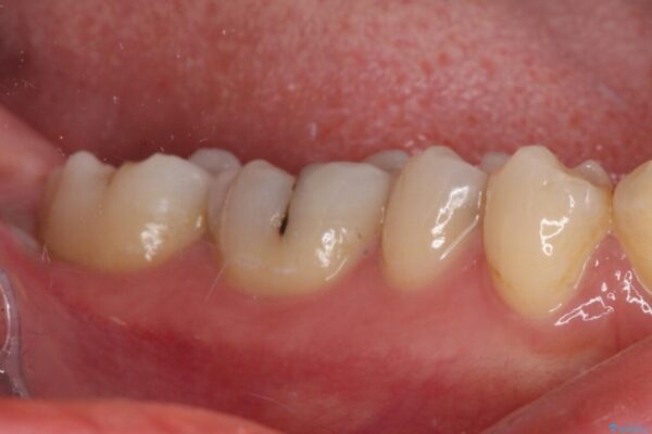 放置した虫歯　根管治療とオールセラミッククラウン 治療前画像