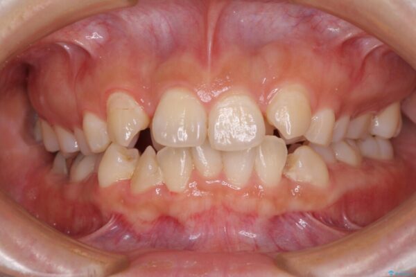 見えないほど重なっている前歯　抜歯矯正でスッキリとした歯並びに ビフォー