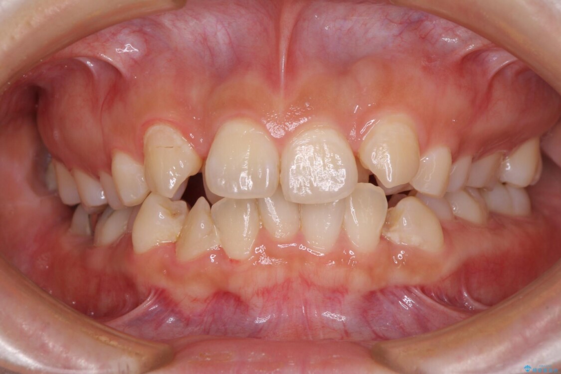 見えないほど重なっている前歯　抜歯矯正でスッキリとした歯並びに 治療前