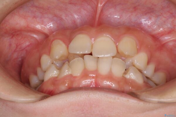 見えないほど重なっている前歯　抜歯矯正でスッキリとした歯並びに 治療前画像