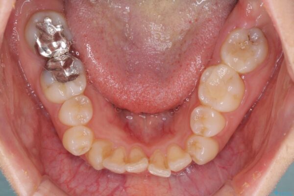見えないほど重なっている前歯　抜歯矯正でスッキリとした歯並びに 治療前画像