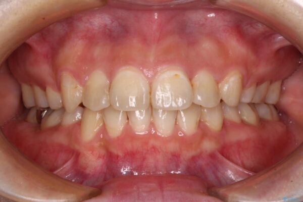 見えないほど重なっている前歯　抜歯矯正でスッキリとした歯並びに アフター