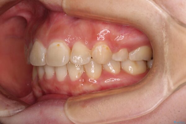 見えないほど重なっている前歯　抜歯矯正でスッキリとした歯並びに 治療後画像