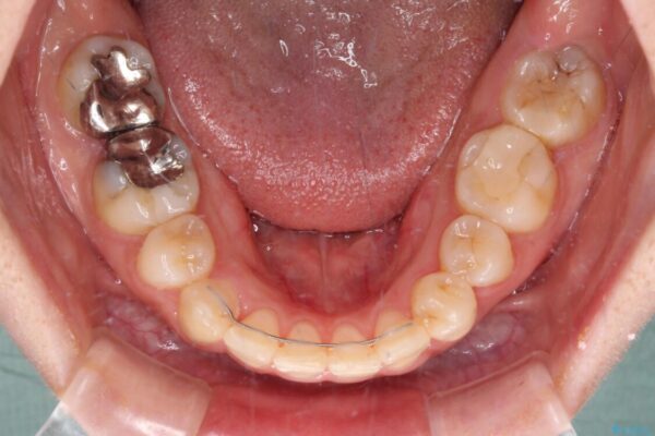 見えないほど重なっている前歯　抜歯矯正でスッキリとした歯並びに 治療後画像