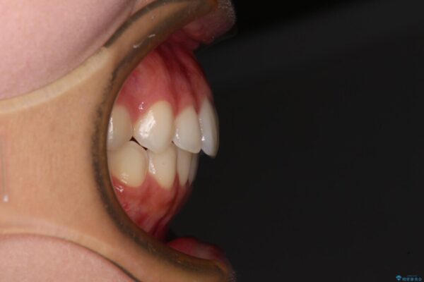 【モニター】前歯のクロスバイトをインビザラインで治療 治療後画像