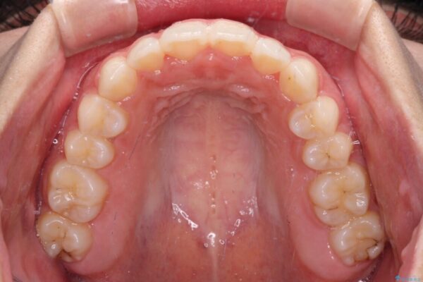 【モニター】前歯のクロスバイトをインビザラインで治療 治療後画像