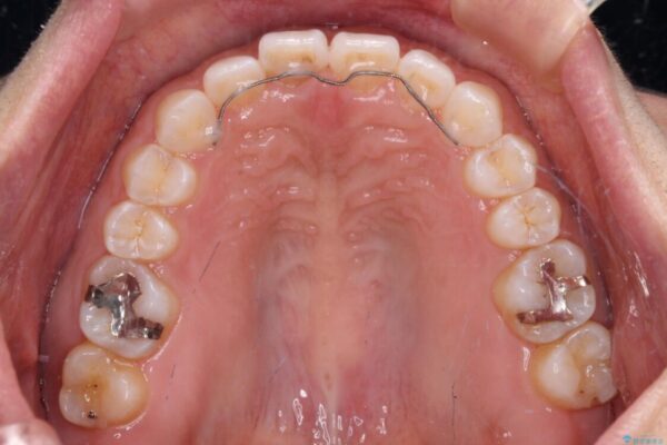 隙間の空いた前歯を閉じたい　インビザライン矯正 治療後画像