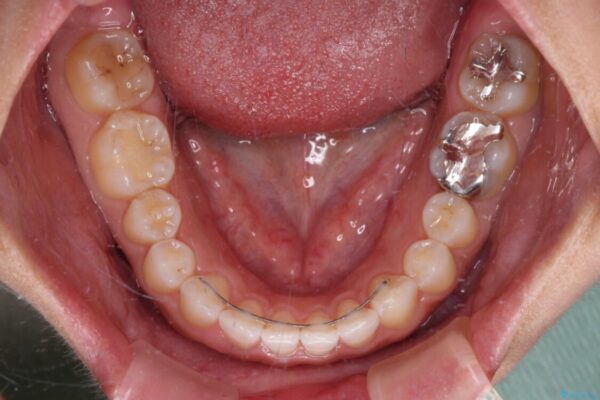 隙間の空いた前歯を閉じたい　インビザライン矯正 治療後画像
