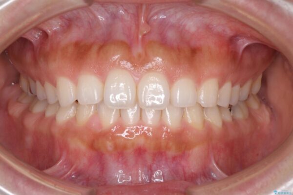隙間の空いた前歯を閉じたい　インビザライン矯正 治療途中画像