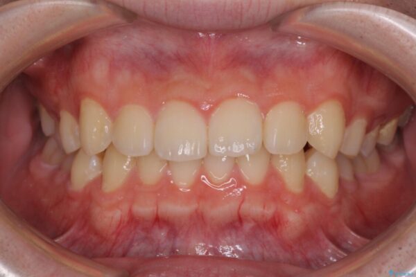 【モニター】斜めに突き出した前歯をインビザラインで改善 治療前画像