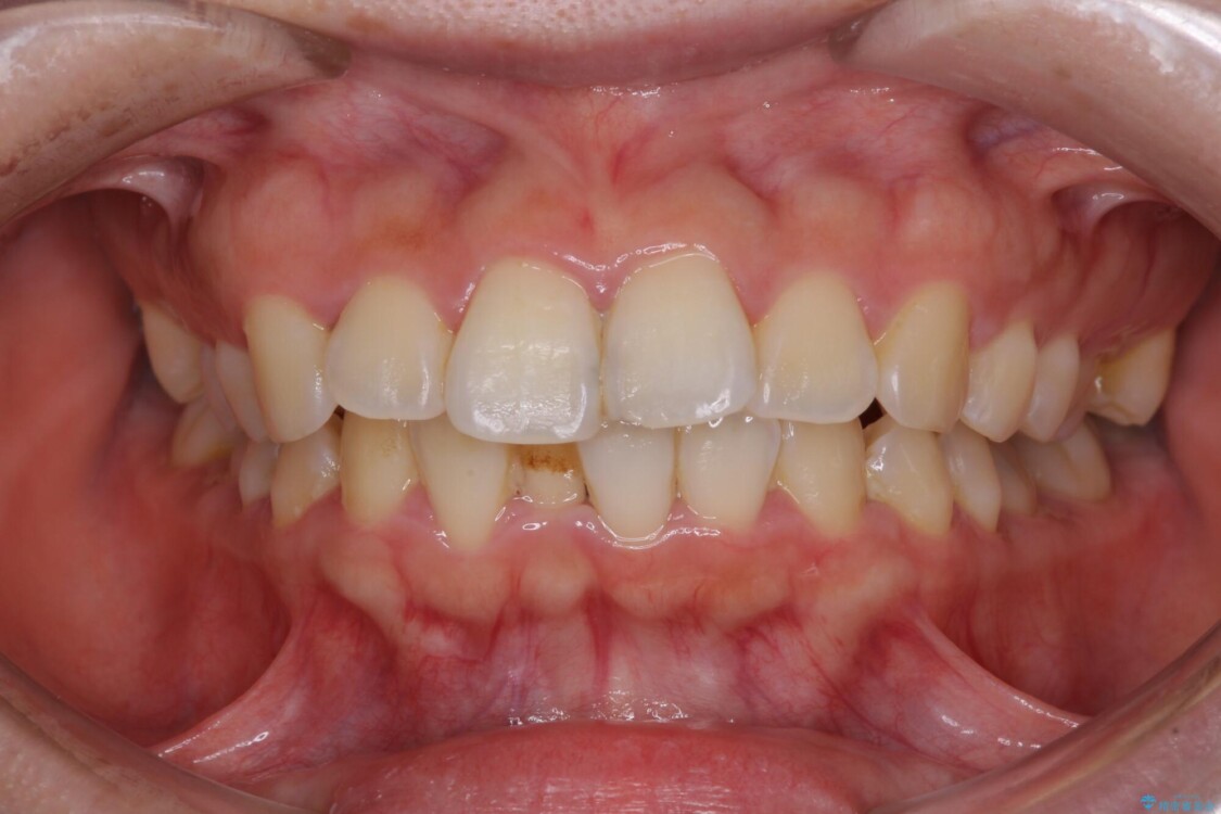 【モニター】短期間で口の閉じにくさを改善　ワイヤー装置での抜歯矯正 治療前
