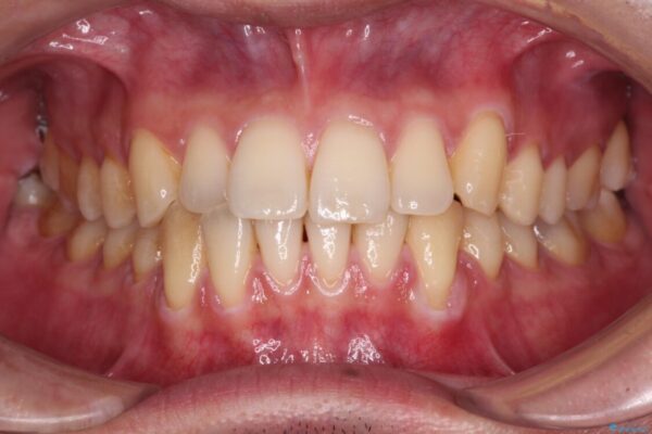 ワイヤー装置での上下前歯の部分矯正 治療前画像