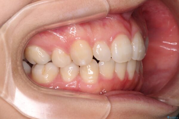 インビザライン・ライトで抜歯矯正の後戻りを解消 治療途中画像