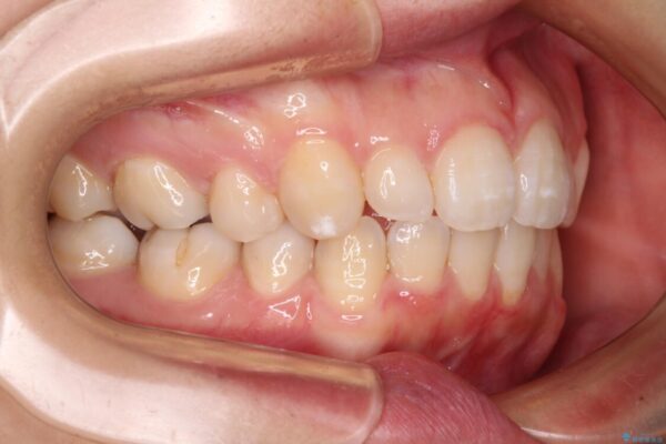 インビザライン・ライトで抜歯矯正の後戻りを解消 治療後画像