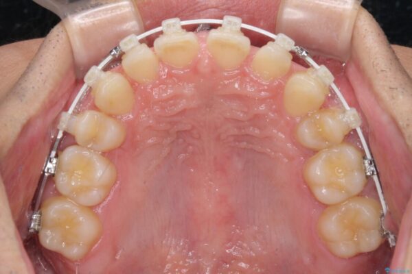 著しいディープバイトと隙間だらけの歯列　 治療途中画像