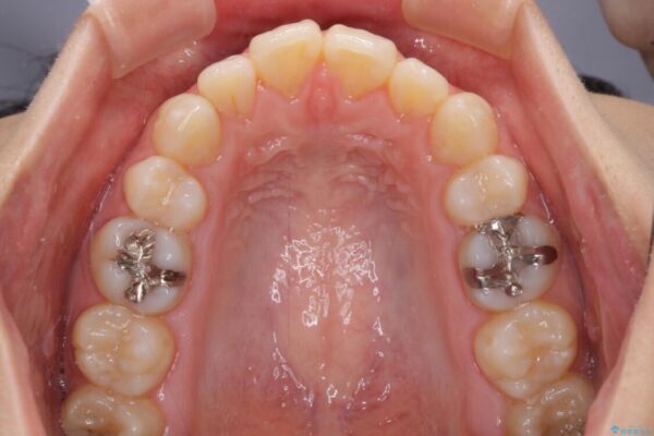 インビザライン・ライトで抜歯矯正の後戻りを解消 治療前画像