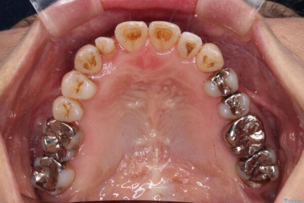 急速拡大装置　前歯の反対咬合をインビザラインで改善 治療途中画像