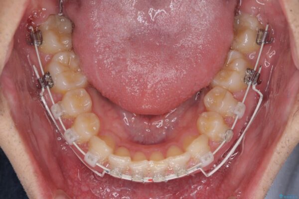 著しいディープバイトと隙間だらけの歯列　 治療途中画像