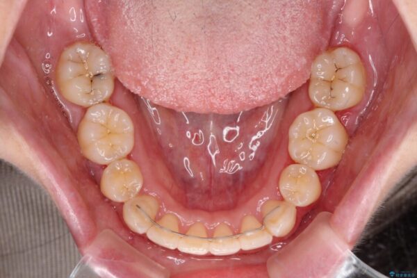 【モニター】短期間で口の閉じにくさを改善　ワイヤー装置での抜歯矯正 治療後画像