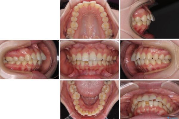 【モニター】短期間で口の閉じにくさを改善　ワイヤー装置での抜歯矯正 治療前画像