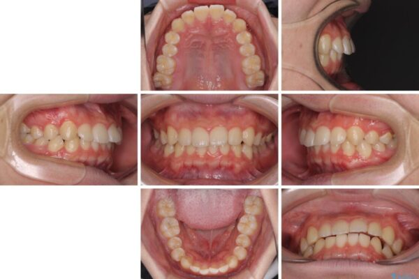 【モニター】斜めに突き出した前歯をインビザラインで改善 治療前画像