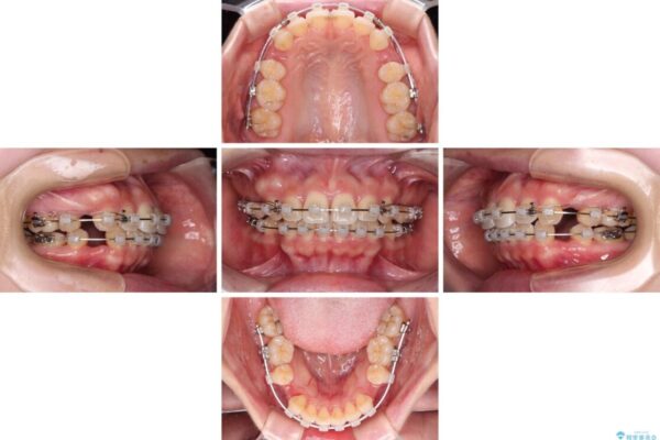 【モニター】短期間で口の閉じにくさを改善　ワイヤー装置での抜歯矯正 治療途中画像
