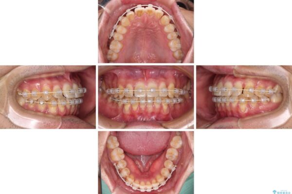 ワイヤー装置での上下前歯の部分矯正 治療途中画像