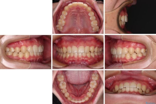 【モニター】斜めに突き出した前歯をインビザラインで改善 治療後画像