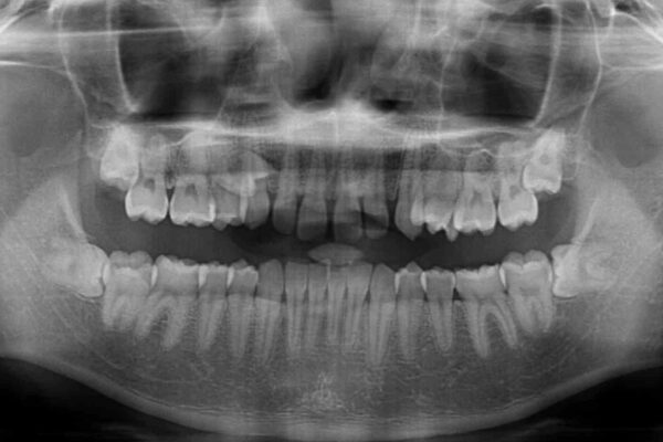 著しいディープバイトと隙間だらけの歯列　 治療前画像