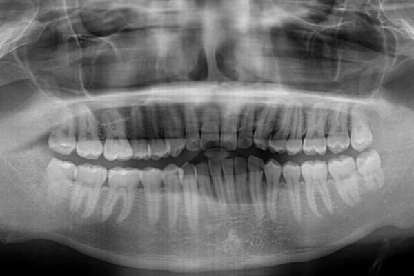 ワイヤー装置での上下前歯の部分矯正 治療前画像