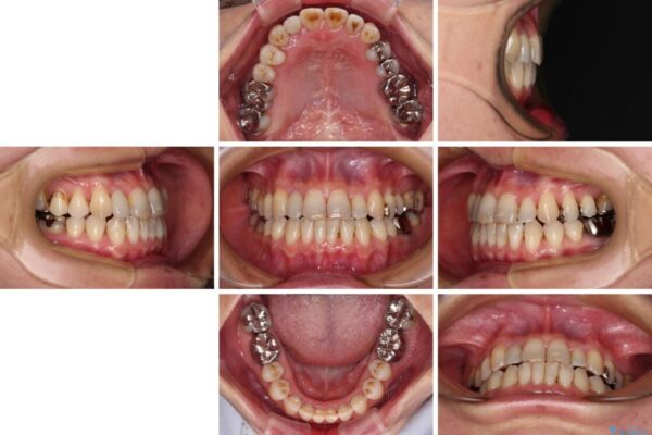 急速拡大装置　前歯の反対咬合をインビザラインで改善 治療後画像