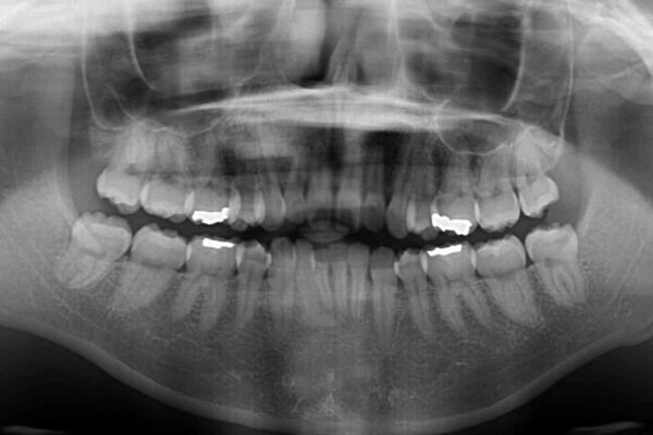 インビザライン・ライトで抜歯矯正の後戻りを解消 治療前画像