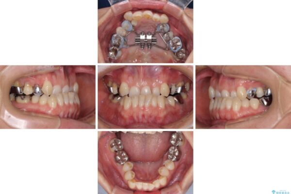 急速拡大装置　前歯の反対咬合をインビザラインで改善 治療前画像