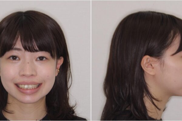 【モニター】短期間で口の閉じにくさを改善　ワイヤー装置での抜歯矯正 治療前画像
