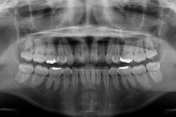 インビザライン・ライトで抜歯矯正の後戻りを解消 治療後画像