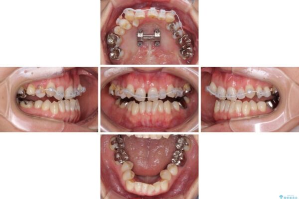 急速拡大装置　前歯の反対咬合をインビザラインで改善 治療途中画像