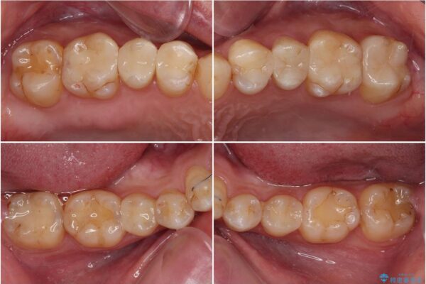 オープンバイトと目立つ銀歯　インビザライン矯正とセラミック修復治療 治療後画像