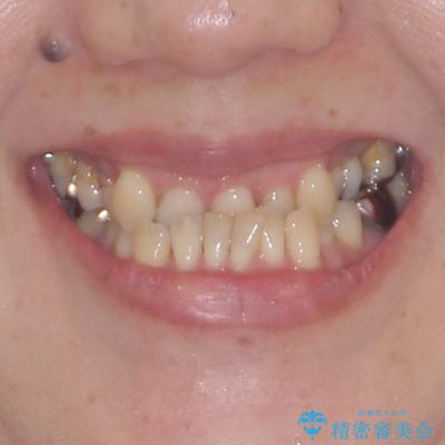 急速拡大装置　前歯の反対咬合をインビザラインで改善 治療前画像