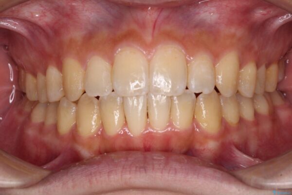 オープンバイトと目立つ銀歯　インビザライン矯正とセラミック修復治療 アフター