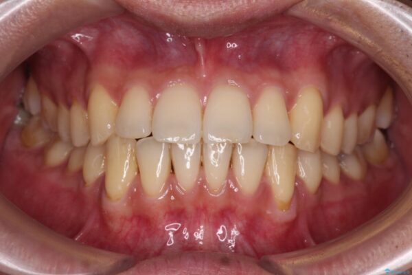 ワイヤー装置での上下前歯の部分矯正 治療後画像
